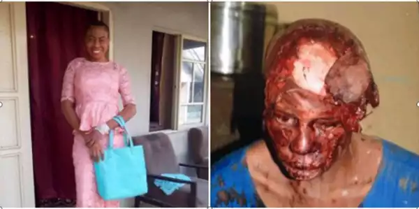 Graphic Photos : NYSC member who survived a tragic accident shares before and after photos